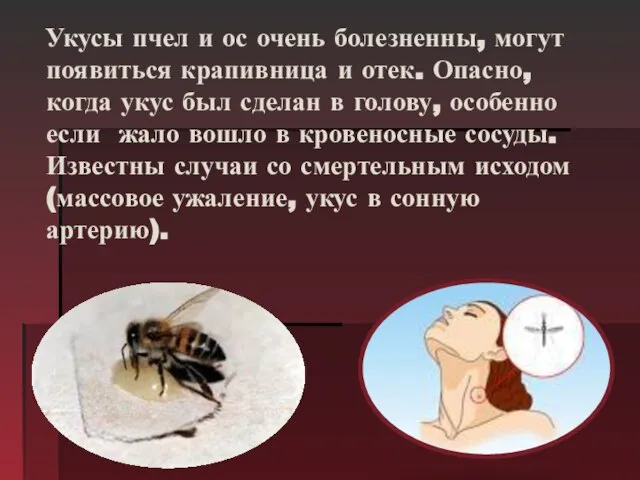 Укусы пчел и ос очень болезненны, могут появиться крапивница и отек.