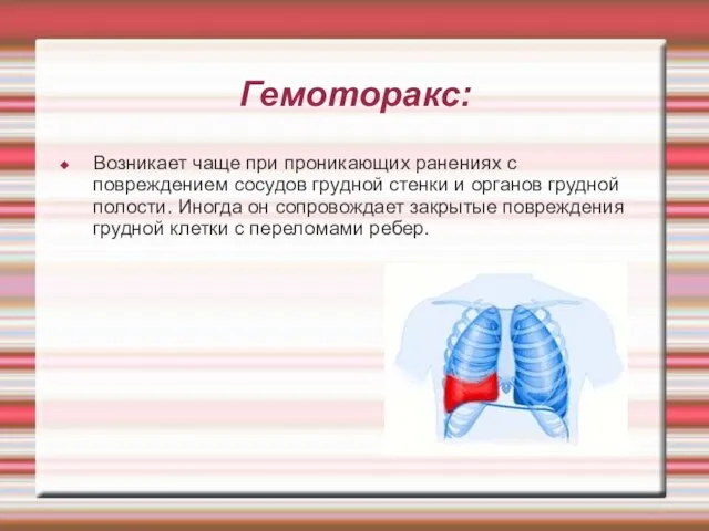 Гемоторакс: Возникает чаще при проникающих ранениях с повреждением сосудов грудной стенки