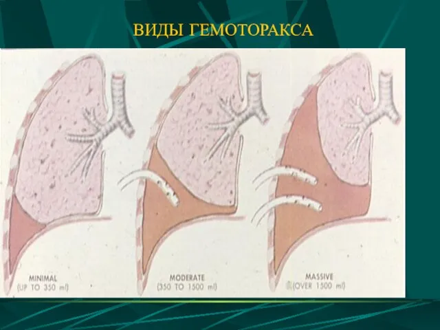 ВИДЫ ГЕМОТОРАКСА ВИДЫ ГЕМОТОРАКСА