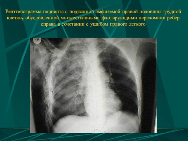 Рентгенограмма пациента с подкожной эмфиземой правой половины грудной клетки, обусловленной множественными