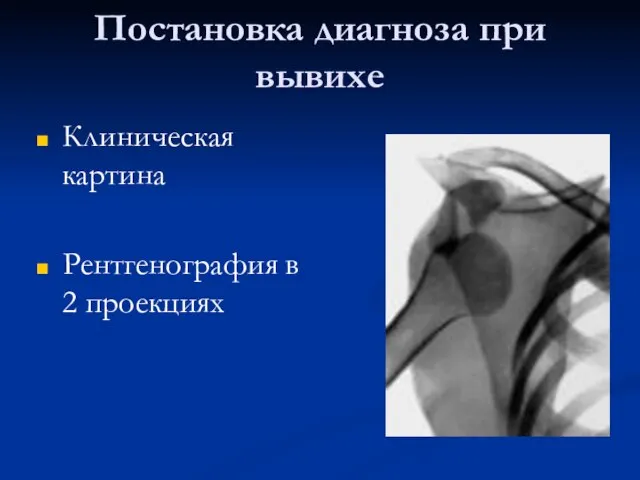 Постановка диагноза при вывихе Клиническая картина Рентгенография в 2 проекциях