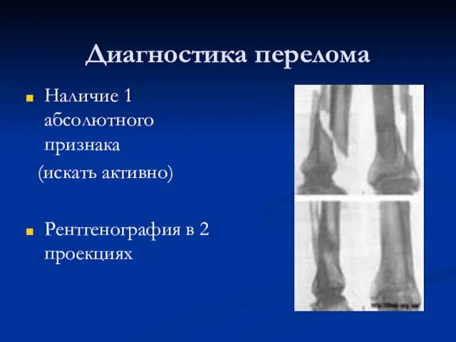 Диагностика перелома Наличие 1 абсолютного признака (искать активно) Рентгенография в 2 проекциях