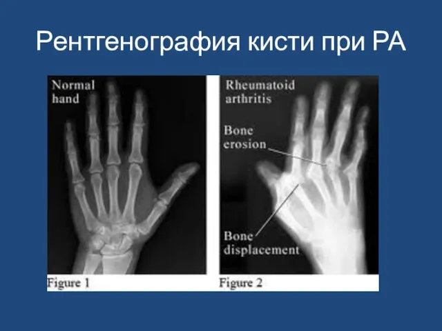 Рентгенография кисти при РА