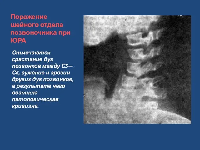 Поражение шейного отдела позвоночника при ЮРА Отмечаются срастание дуг позвонков между