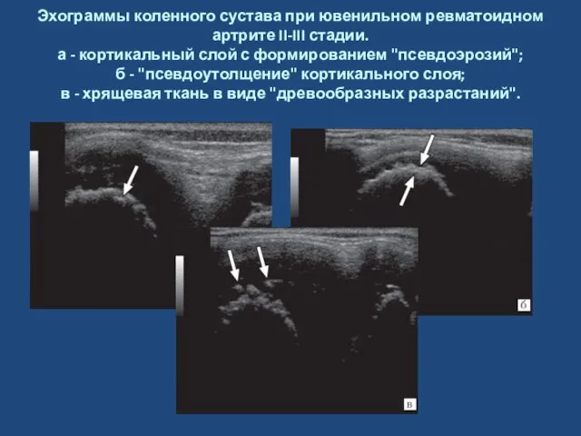 Эхограммы коленного сустава при ювенильном ревматоидном артрите II-III стадии. а -