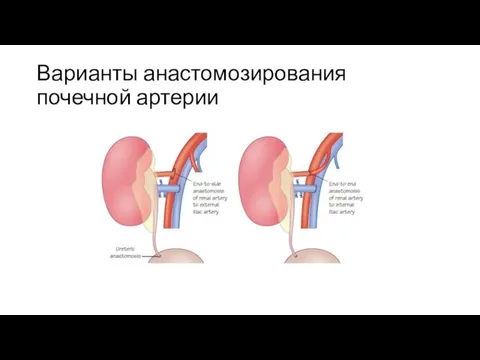 Варианты анастомозирования почечной артерии