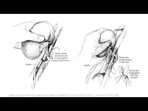 Kidney transplantation: principles and practice / [edited by] Sir Peter J.Morris,