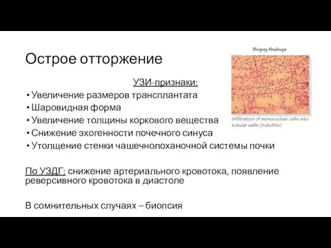 Острое отторжение УЗИ-признаки: Увеличение размеров трансплантата Шаровидная форма Увеличение толщины коркового