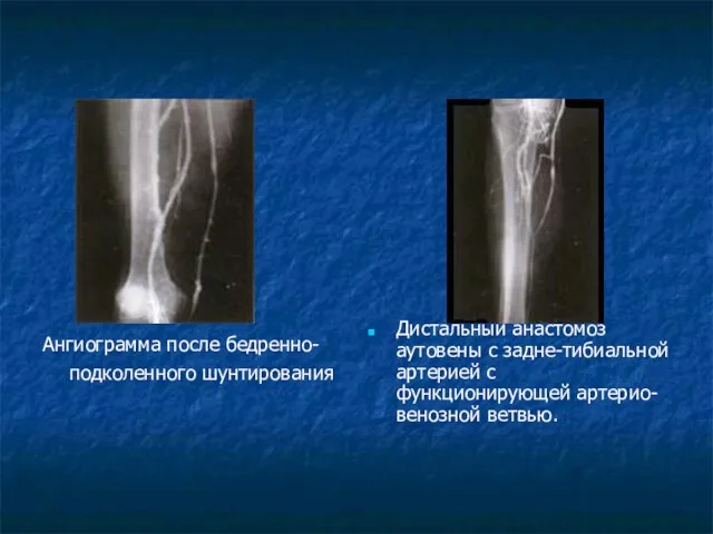 Ангиограмма после бедренно- подколенного шунтирования Дистальный анастомоз аутовены с задне-тибиальной артерией с функционирующей артерио-венозной ветвью.