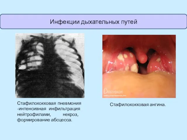 Стафилококковая пневмония -интенсивная инфильтрация нейтрофилами, некроз, формирование абсцесса. Стафилококковая ангина. Инфекции дыхательных путей