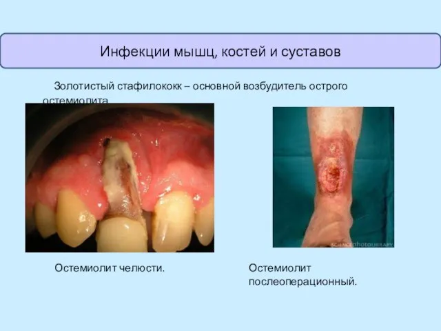 Золотистый стафилококк – основной возбудитель острого остемиолита. Остемиолит челюсти. Остемиолит послеоперационный. Инфекции мышц, костей и суставов
