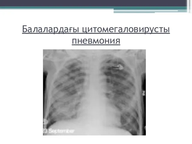 Балалардағы цитомегаловирусты пневмония