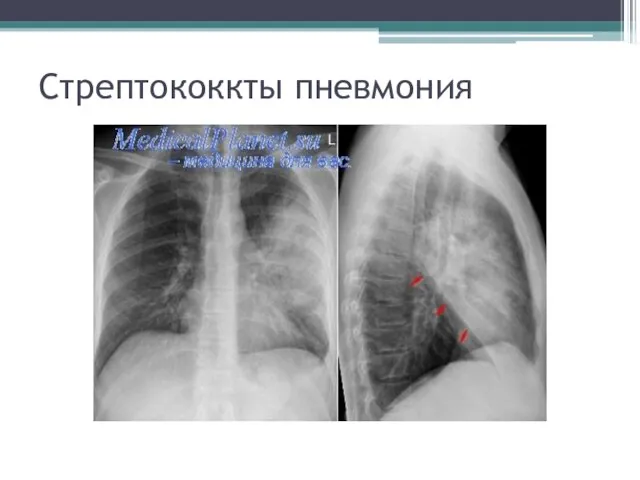 Стрептококкты пневмония