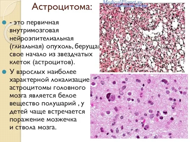 Астроцитома: - это первичная внутримозговая нейроэпителиальная (глиальная) опухоль, берущая свое начало