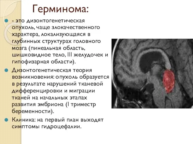 Герминома: - это дизонтогенетическая опухоль, чаще злокачественного характера, локализующаяся в глубинных
