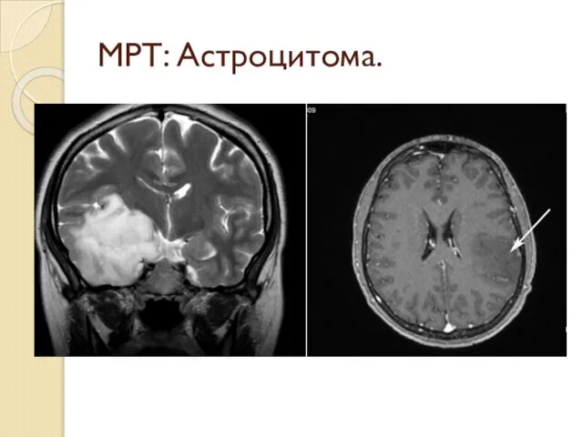 МРТ: Астроцитома.