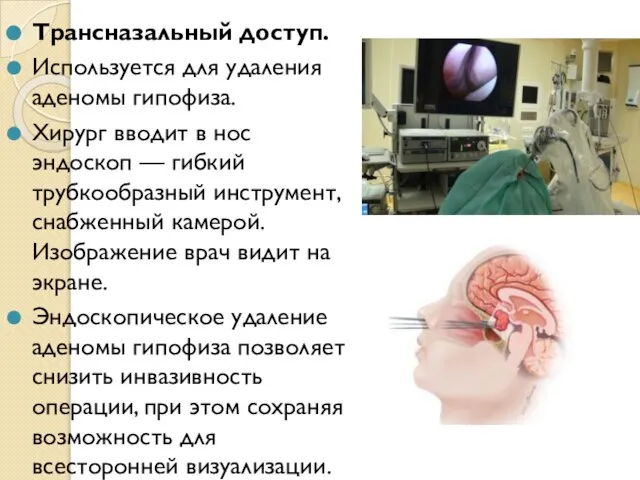 Трансназальный доступ. Используется для удаления аденомы гипофиза. Хирург вводит в нос