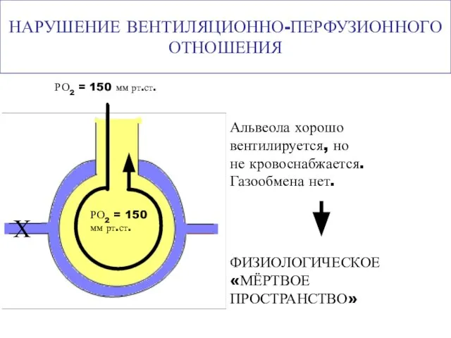 НАРУШЕНИЕ ВЕНТИЛЯЦИОННО-ПЕРФУЗИОННОГО ОТНОШЕНИЯ Альвеола хорошо вентилируется, но не кровоснабжается. Газообмена нет.