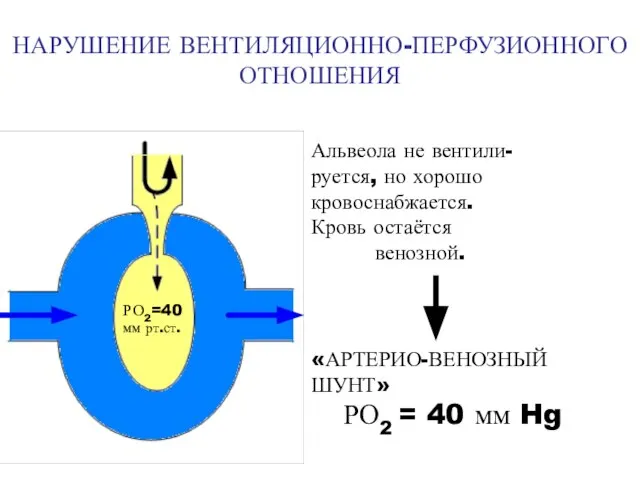 НАРУШЕНИЕ ВЕНТИЛЯЦИОННО-ПЕРФУЗИОННОГО ОТНОШЕНИЯ Альвеола не вентили- руется, но хорошо кровоснабжается. Кровь