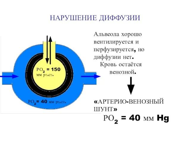 НАРУШЕНИЕ ДИФФУЗИИ Альвеола хорошо вентилируется и перфузируется, но диффузии нет. Кровь