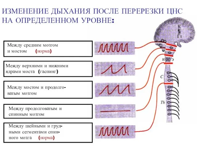 Между средним мозгом и мостом (норма) Между верхними и нижними ядрами