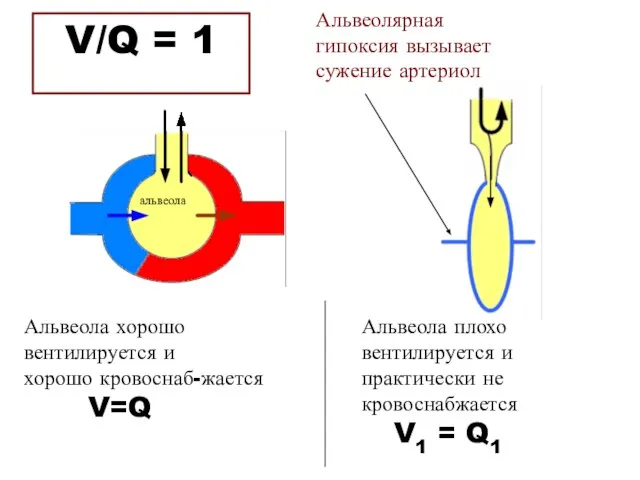 V/Q = 1 Альвеола хорошо вентилируется и хорошо кровоснаб-жается V=Q Альвеола