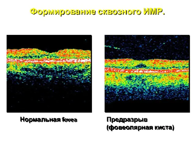 Формирование сквозного ИМР. Нормальная fovea Предразрыв (фовеолярная киста)