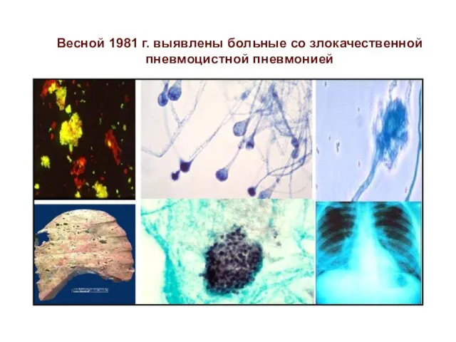 Весной 1981 г. выявлены больные со злокачественной пневмоцистной пневмонией .