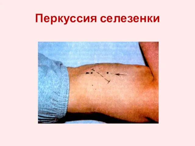 Перкуссия селезенки