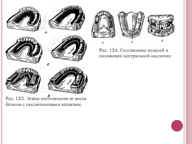 Рис. 123. Этапы изготовления из воска базисов с окклюзионными валиками. Рис.
