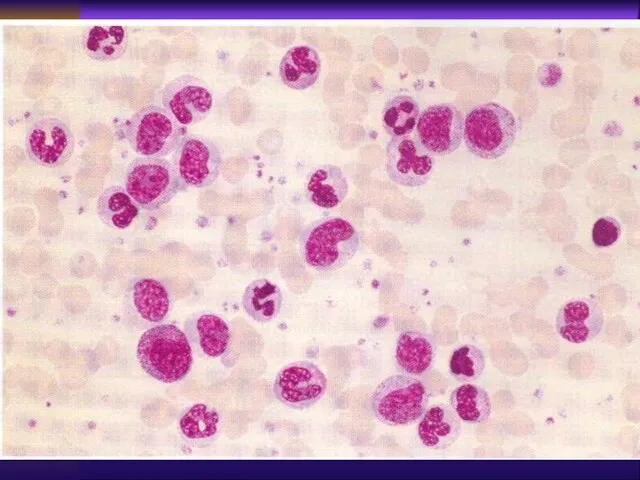 Laboratory Peripheral blood : leukocytosis with “left shift”, basophillia, eeosinophilia, thrombocytosis,