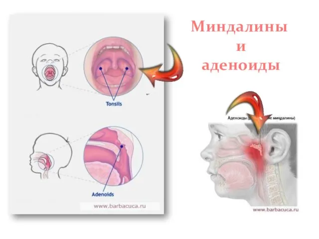 Миндалины и аденоиды