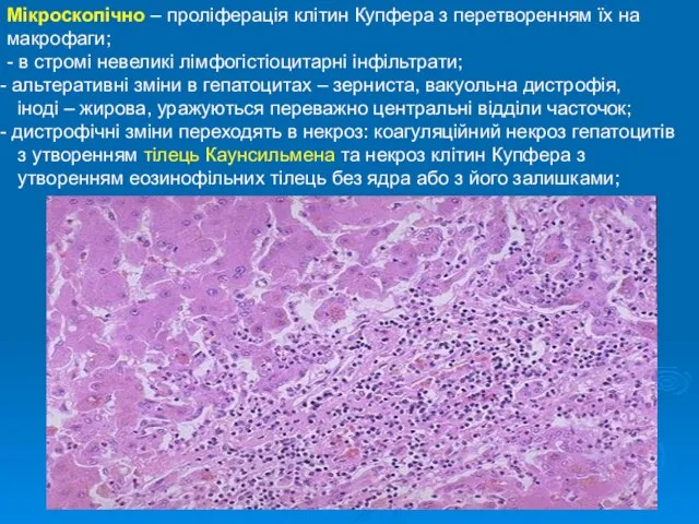 Мікроскопічно – проліферація клітин Купфера з перетворенням їх на макрофаги; -