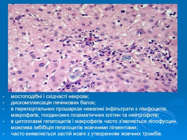 мостоподібні і східчасті некрози; дискомплексація печінкових балок; в перипортальних прошарках невеликі
