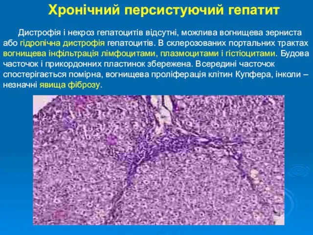 Хронічний персистуючий гепатит Дистрофія і некроз гепатоцитів відсутні, можлива вогнищева зерниста