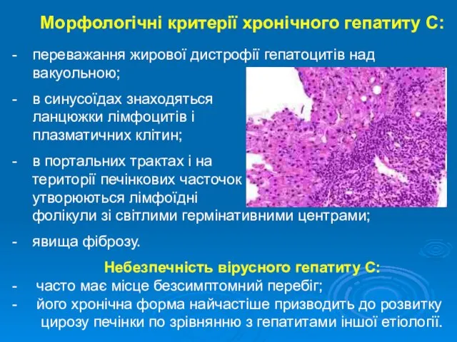 Морфологічні критерії хронічного гепатиту С: переважання жирової дистрофії гепатоцитів над вакуольною;