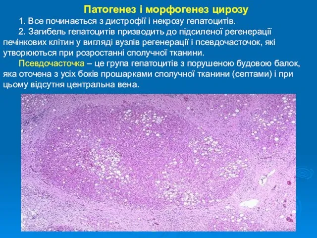 Патогенез і морфогенез цирозу 1. Все починається з дистрофії і некрозу