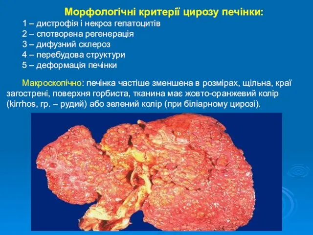 Морфологічні критерії цирозу печінки: 1 – дистрофія і некроз гепатоцитів 2