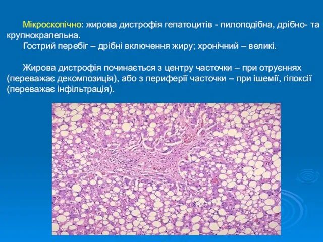 Мікроскопічно: жирова дистрофія гепатоцитів - пилоподібна, дрібно- та крупнокрапельна. Гострий перебіг