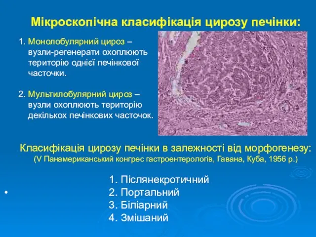 Мікроскопічна класифікація цирозу печінки: 1. Монолобулярний цироз – вузли-регенерати охоплюють територію