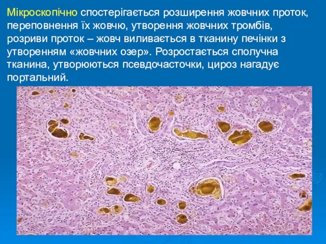 Мікроскопічно спостерігається розширення жовчних проток, переповнення їх жовчю, утворення жовчних тромбів,
