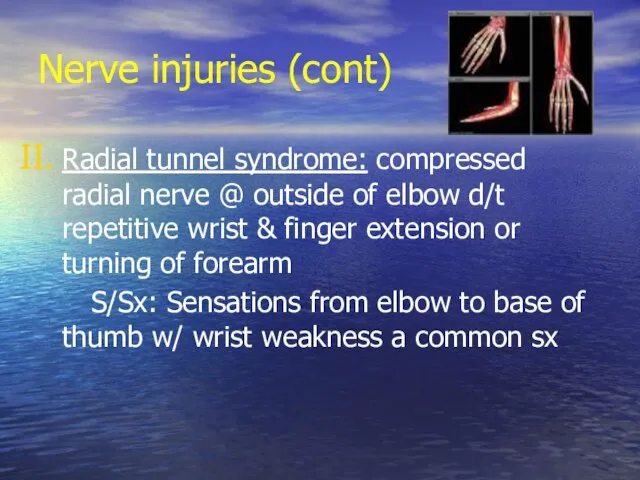 Nerve injuries (cont) Radial tunnel syndrome: compressed radial nerve @ outside