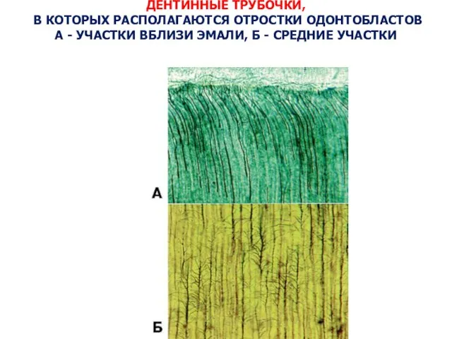 ДЕНТИННЫЕ ТРУБОЧКИ, В КОТОРЫХ РАСПОЛАГАЮТСЯ ОТРОСТКИ ОДОНТОБЛАСТОВ А - УЧАСТКИ ВБЛИЗИ ЭМАЛИ, Б - СРЕДНИЕ УЧАСТКИ