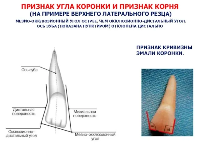 ПРИЗНАК УГЛА КОРОНКИ И ПРИЗНАК КОРНЯ (НА ПРИМЕРЕ ВЕРХНЕГО ЛАТЕРАЛЬНОГО РЕЗЦА)