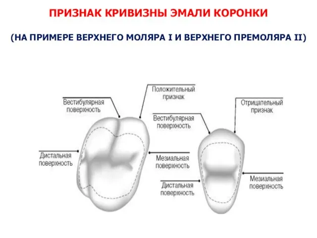 ПРИЗНАК КРИВИЗНЫ ЭМАЛИ КОРОНКИ (НА ПРИМЕРЕ ВЕРХНЕГО МОЛЯРА I И ВЕРХНЕГО ПРЕМОЛЯРА II)