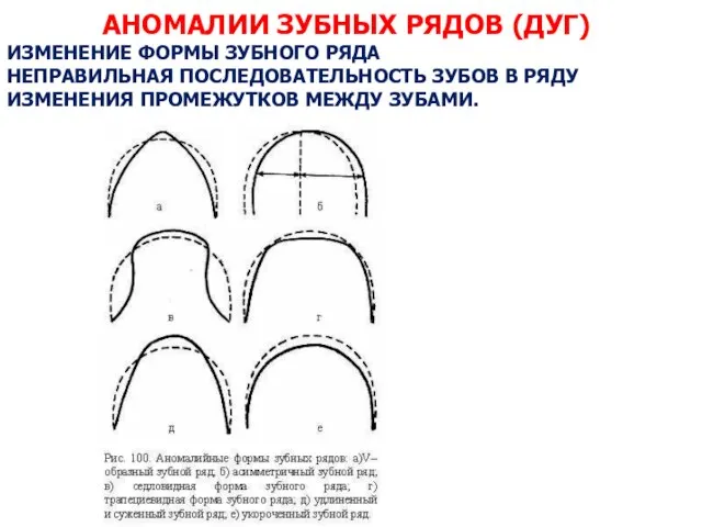 АНОМАЛИИ ЗУБНЫХ РЯДОВ (ДУГ) ИЗМЕНЕНИЕ ФОРМЫ ЗУБНОГО РЯДА НЕПРАВИЛЬНАЯ ПОСЛЕДОВАТЕЛЬНОСТЬ ЗУБОВ