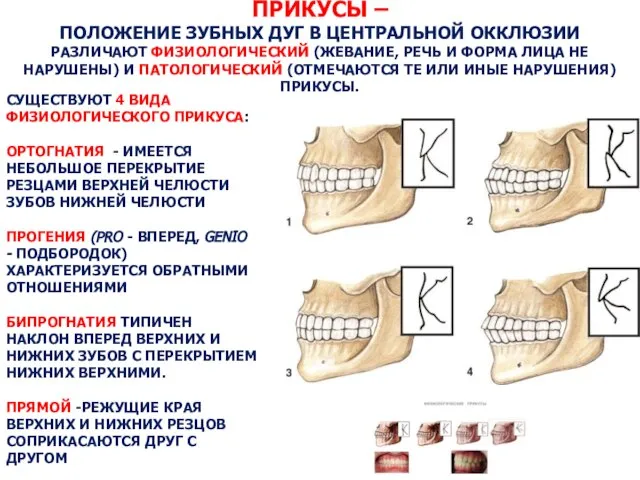 ПРИКУСЫ – ПОЛОЖЕНИЕ ЗУБНЫХ ДУГ В ЦЕНТРАЛЬНОЙ ОККЛЮЗИИ РАЗЛИЧАЮТ ФИЗИОЛОГИЧЕСКИЙ (ЖЕВАНИЕ,