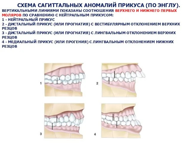 СХЕМА САГИТТАЛЬНЫХ АНОМАЛИЙ ПРИКУСА (ПО ЭНГЛУ). ВЕРТИКАЛЬНЫМИ ЛИНИЯМИ ПОКАЗАНЫ СООТНОШЕНИЯ ВЕРХНЕГО