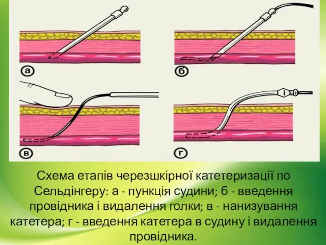 Схема етапів черезшкірної катетеризації по Сельдінгеру: а - пункція судини; б