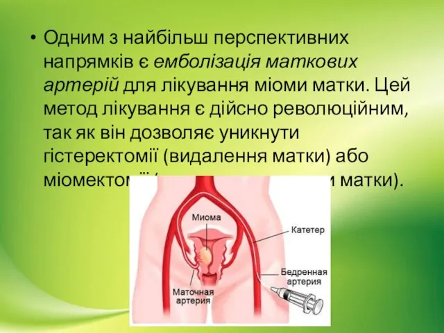 Одним з найбільш перспективних напрямків є емболізація маткових артерій для лікування